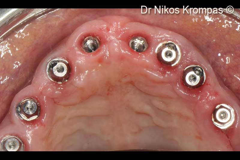 11. Occlusal view. Note the thickness and quality of the soft tissues