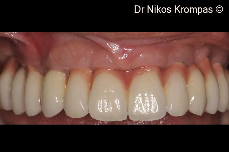 12. Final reconstruction