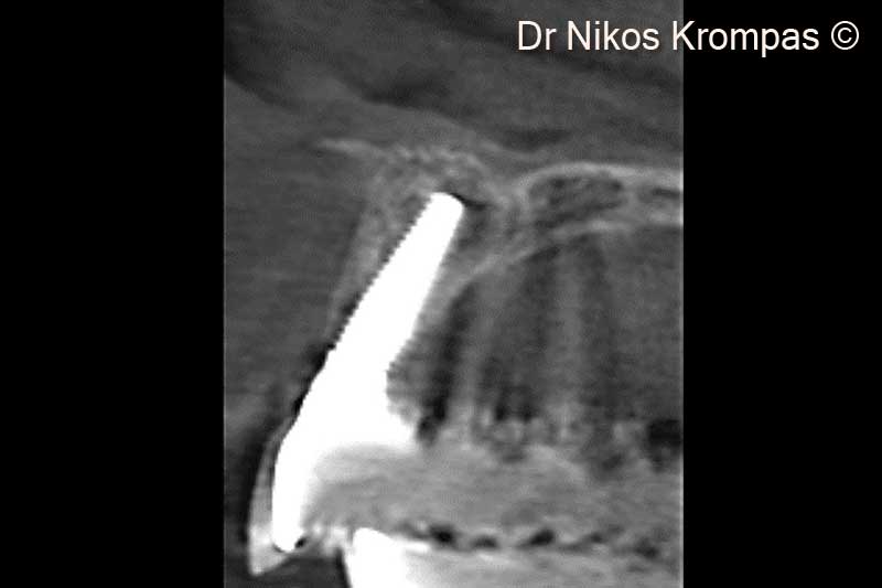 15. Cross section 2 years post-op. Note the adequate buccal plate thickness