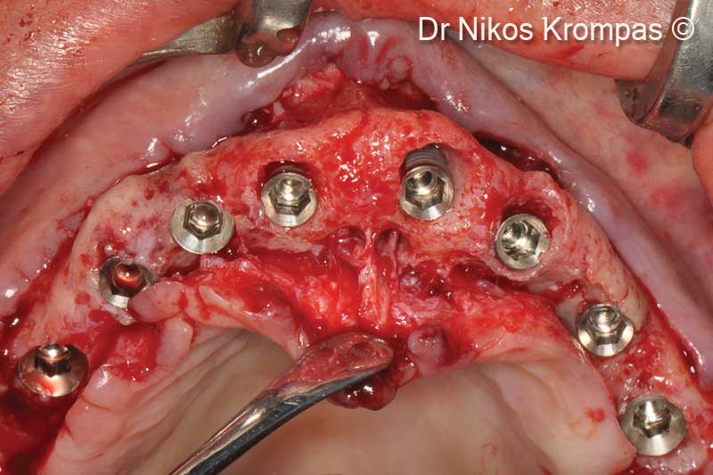 2. Buccal perforation and thin buccal bone