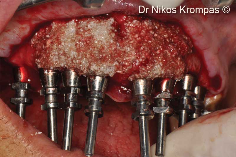 5. Buccal view of graft in place