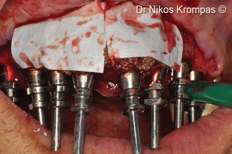 6. OsteoBiol® Evolution collagen membranes in place