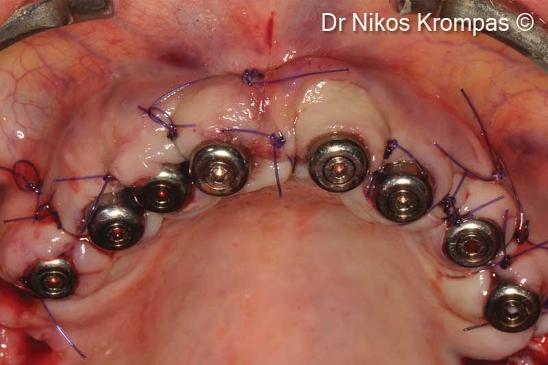 8. Flap closure without tension