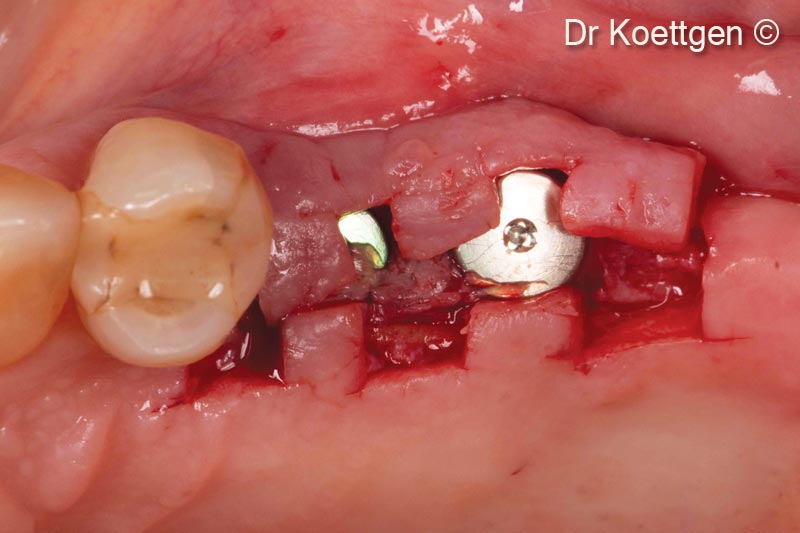 10. Uncovering with split finger technique 3 months after implantation