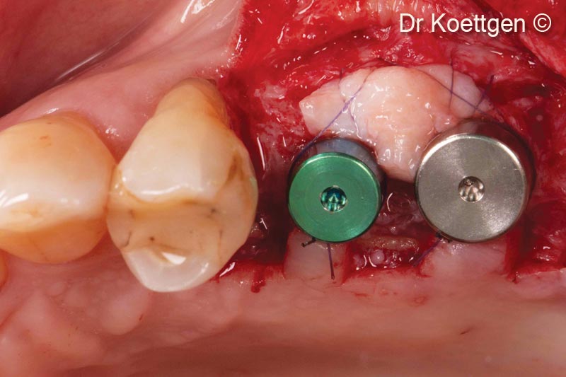11. Uncovering with split finger technique 3 months after implantation