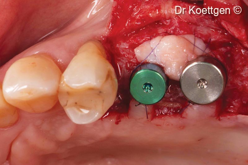 12. Free gingival graft