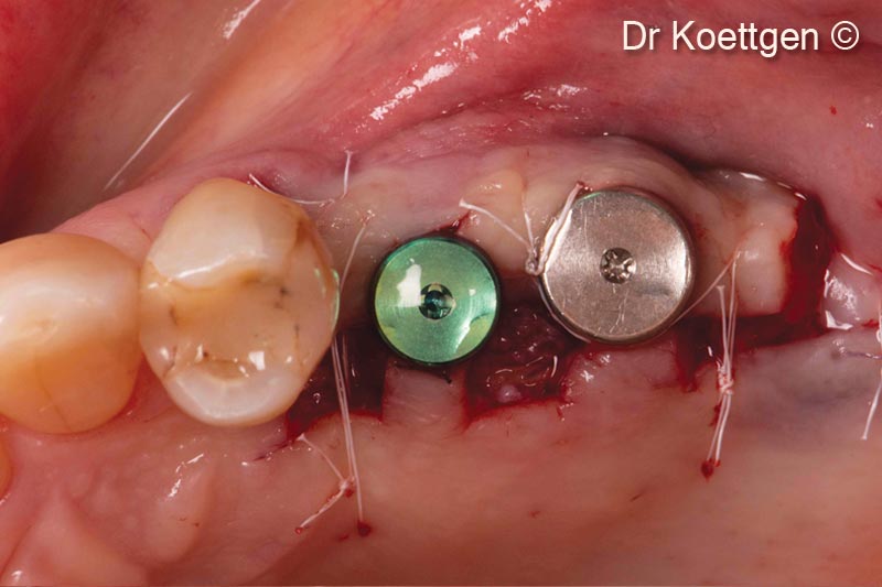 13. Sutured situation