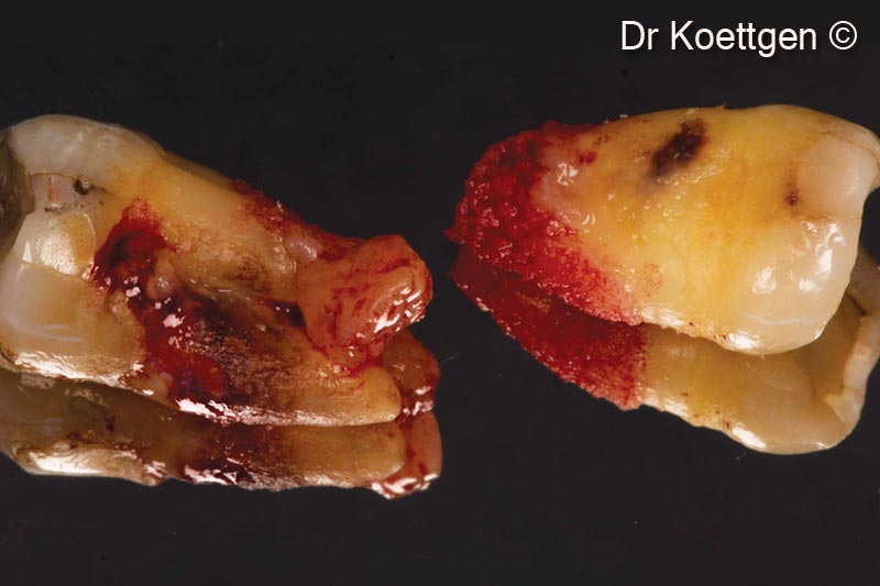 3. Extracted teeth (massive attachment loss)