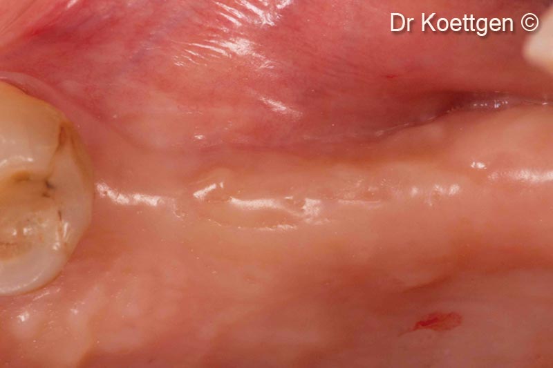 4. Healed ridge with loss of hard and soft tissue