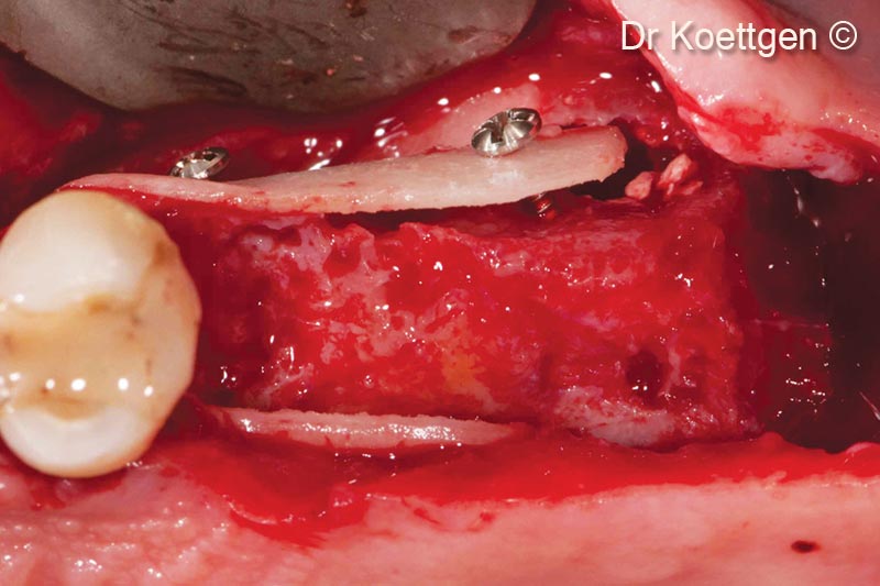 6. 3D build up of buccal and palatal wall with Tecnoss® Lamina® (0.8 mm)