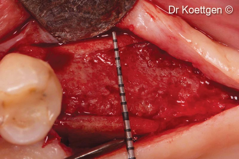 8. Healed side after 3 months