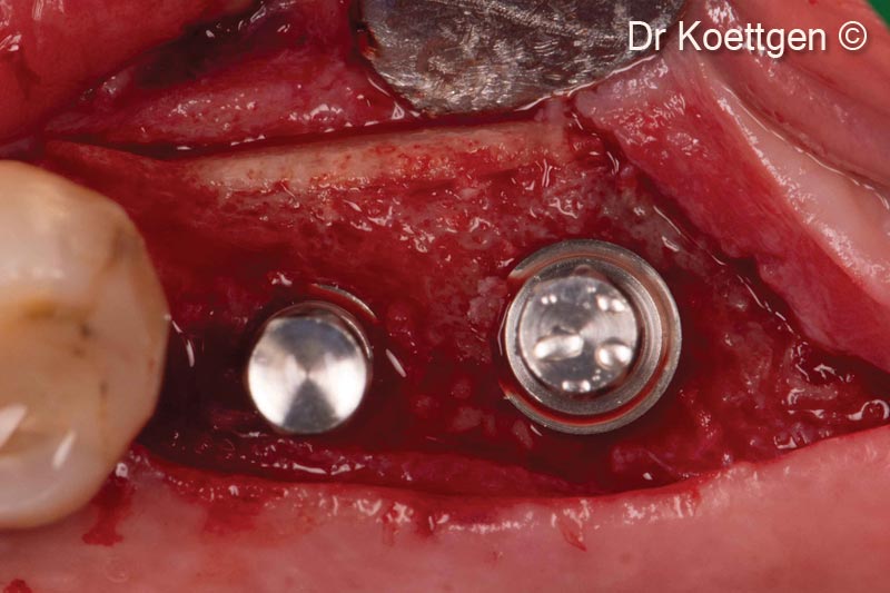 9. Insertion of implants