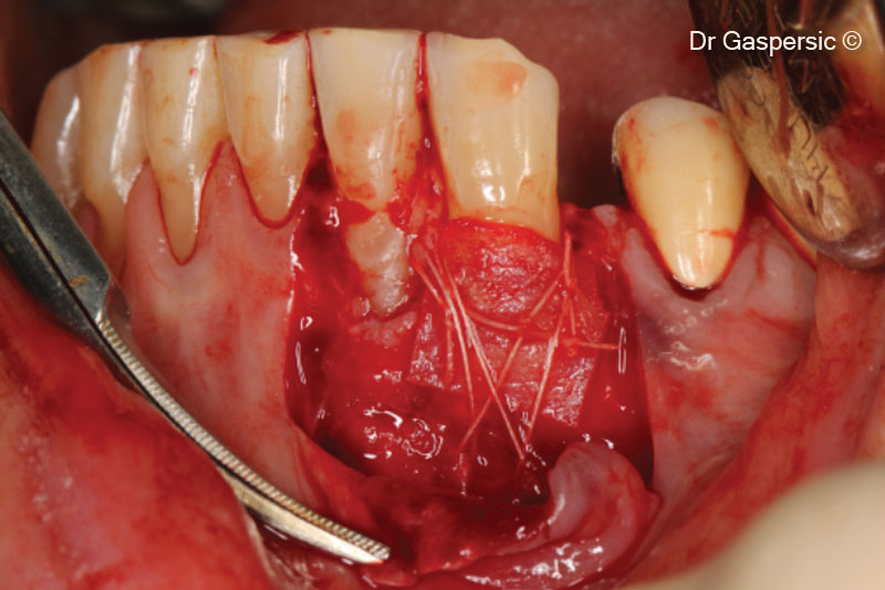 11. Additional compressing cross sutures