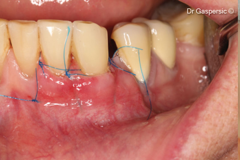 13. Healing at 1 week