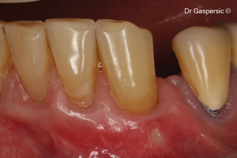 14. 2 years follow-up