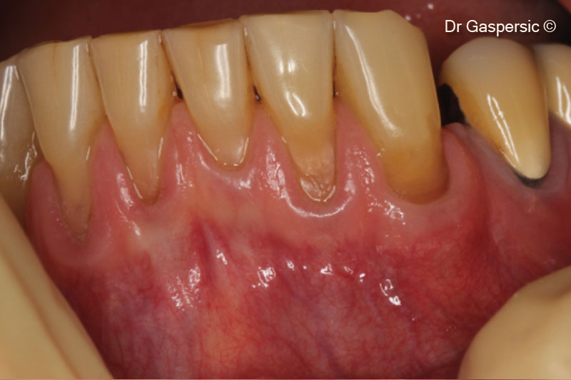 2. Recession defects and erosions