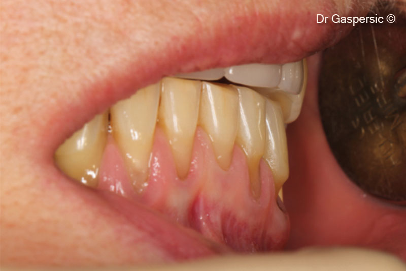 3. Recession defects and erosions