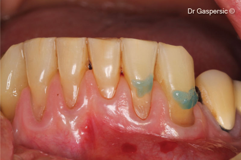4. Enamel etching before restoration of enamel defects