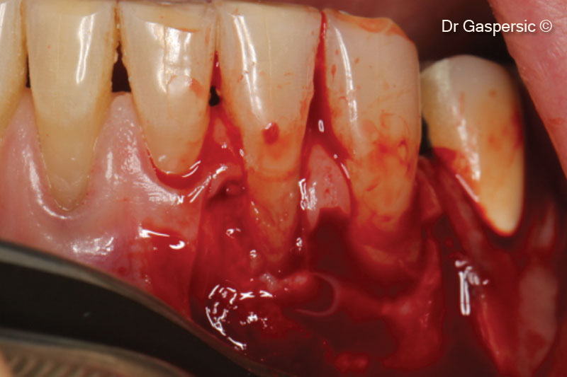 6. Split thickness flap elevation