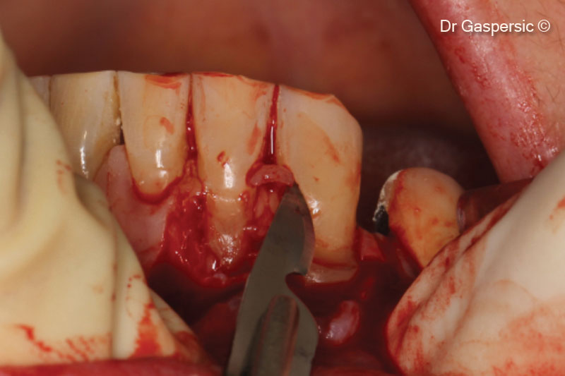 7. Depithelization of papillas