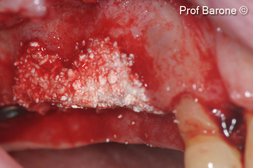 3. Bone graft with Gen-Os® and TSV Gel