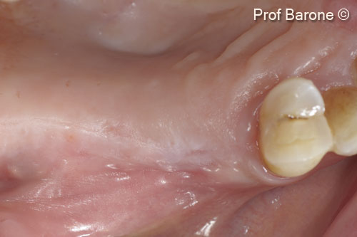 6. Soft tissue healing 6 months after surgery