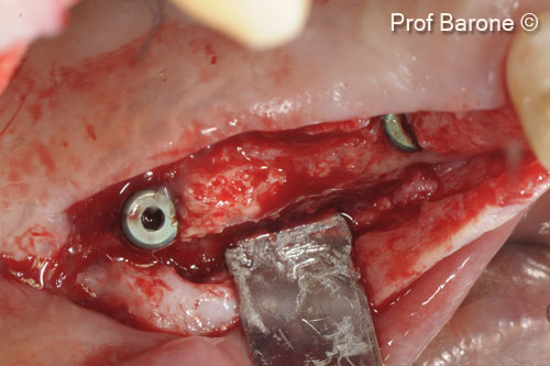 7.  Second stage of surgery 6 months after surgery