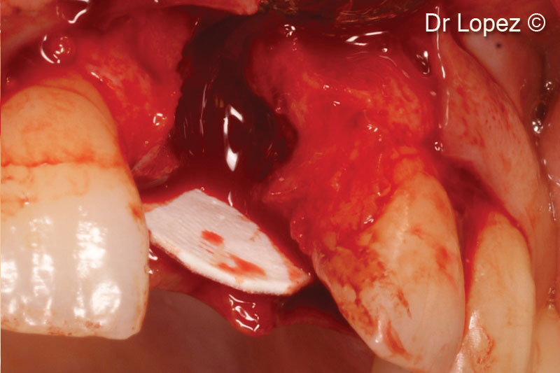 5. 1-mm thick OsteoBiol® Lamina® Soft positioned palatally