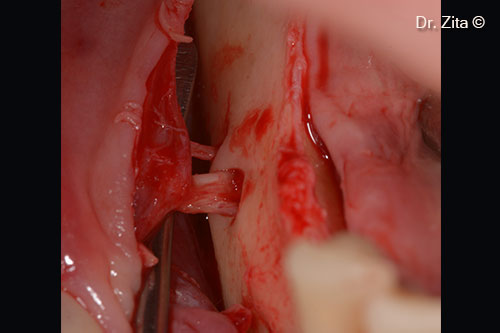 4. Mental (main and accessory) nerves exposed and individualized