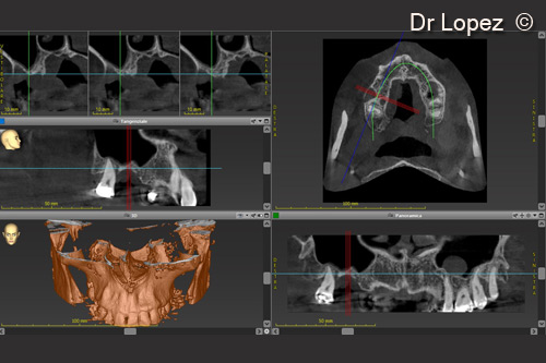 1. TC at starting point. Severe vertical atrophy on 16 site
