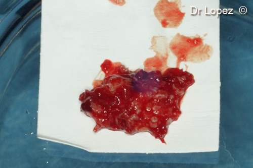 2. Mixed graft of GTO® and scraped bone in ratio 50% positioned on a x fine Evolution membrane