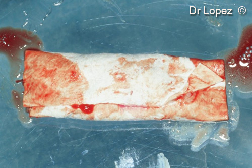 3. Wrapped membrane to prepare a graft pack going into the sinus