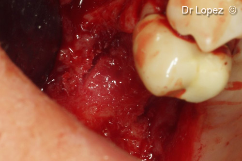 5. Two bone slots of 2 mm depth prepared on vestibular and palatine sides ready to receive Curved Lamina®