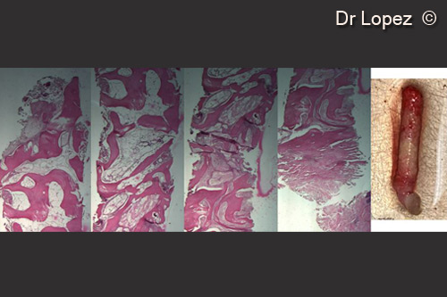 7. Hystologic samples after 8 months with different layer of resorption and remodelling bone