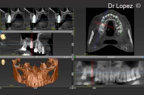8. TC after 8 months after positionment of the implant