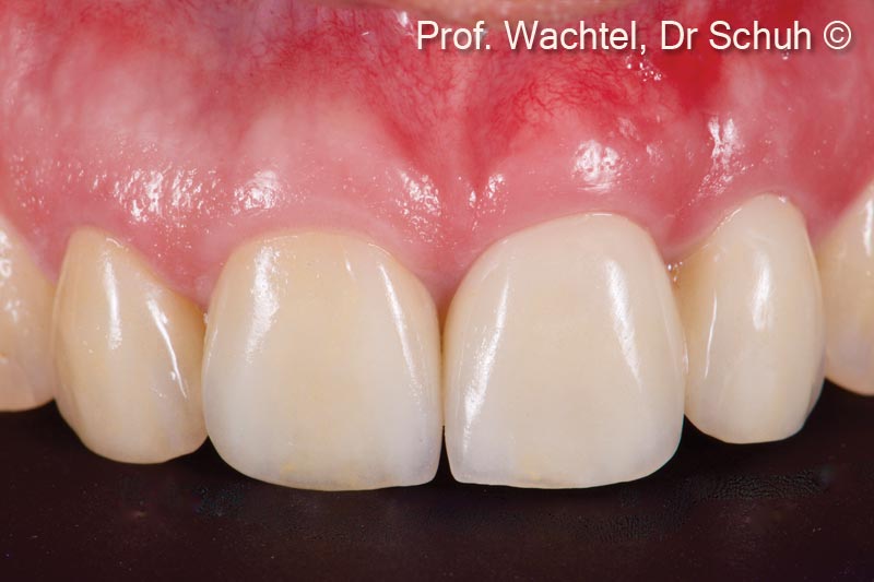2. Final treatment outcome after extraction of tooth #21, and #22 and implant placement, immediate restoration and site development according to the MLT. New full ceramic crowns from #11 - #22