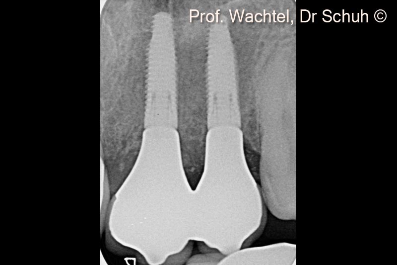 4. X-ray of the 2 implants: #21 and #22. Note the harmonious hard tissue architecture