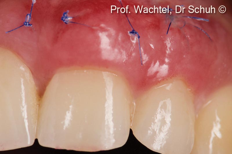 5. Frontal view immediately before removing the sutures 10 days after surgery