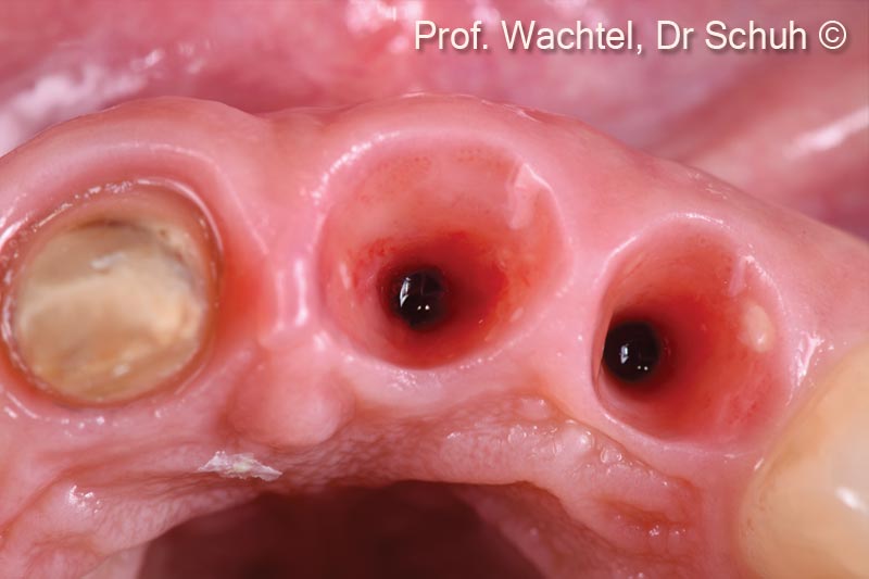 6. Immediate implant placement and reconstruction of the hard and soft tissue components. Ideal site development of hard and soft tissue around the implants