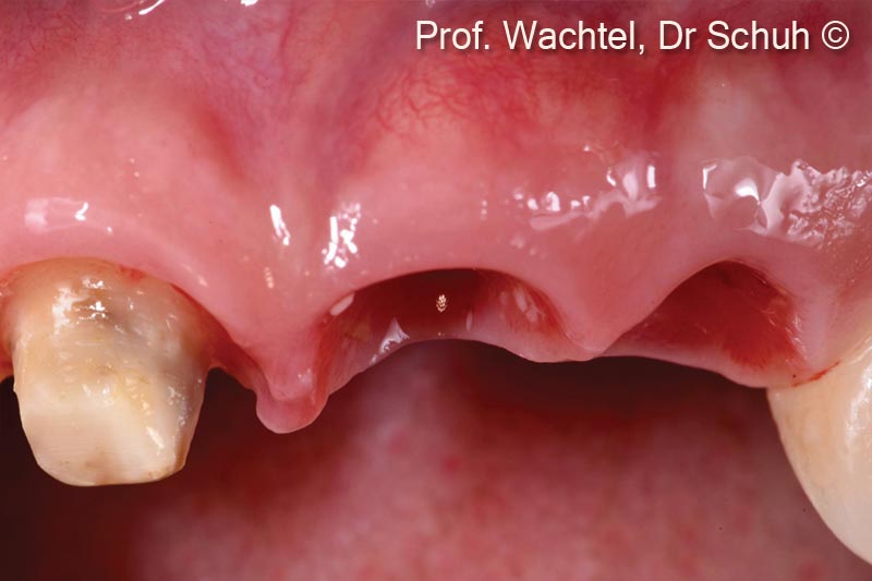 7. Frontal view after 3 months before final restoration