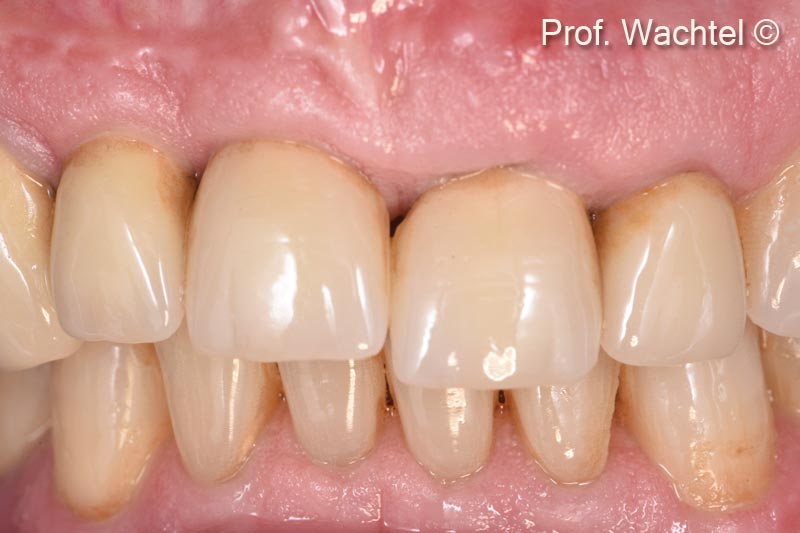 1. Patient received implants #12 and #11 in 2001. Tooth #21 is failing, presenting a fistula and a root fracture. Note the vertical discrepancy of the gingival and incisal line