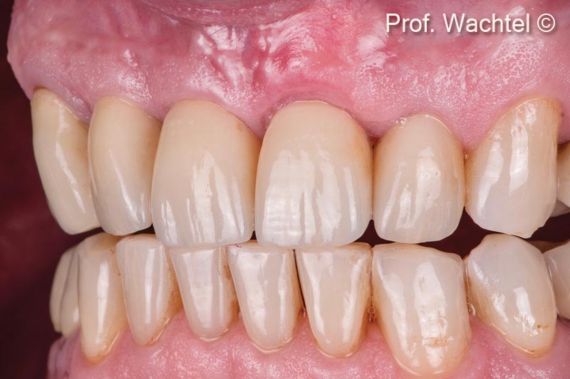 6. Final treatment result after extraction of tooth #21, implantation, immediate restoration and site development according to the Multi Layer Technique (MLT) and new full ceramic crowns #12 - #22