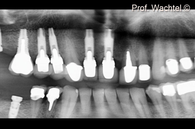 2. Panoramic view before treatment. #21 not maintainable presenting a large apical lesion