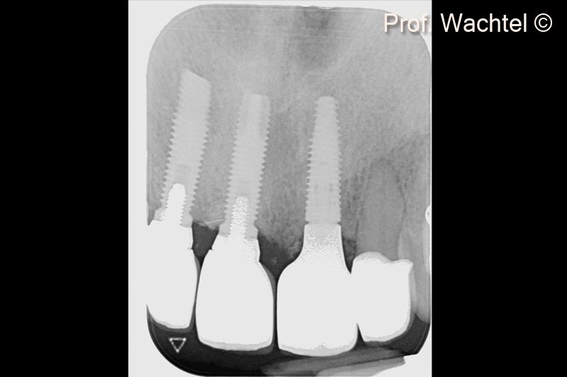 5. X-ray of the 3 implants: #12 and #11 18 years old - #21 implantation according to the Multi Layer Technique (MLT)
