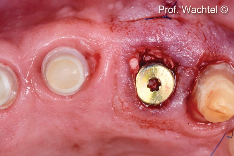 3. Immediate implant placement and reconstruction of the missing buccal bony plate with a OsteoBiol® Lamina® Soft and CT graft. The gap is filled with OsteoBiol® mp3®