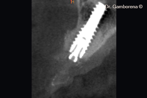 20. CBCT at 6 months post-op