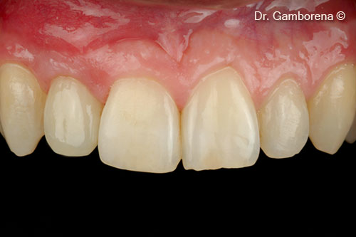 23. Restoration after 1 year