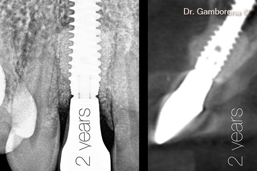 25. X-rays after 2 years