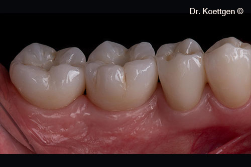 10. Final restoration