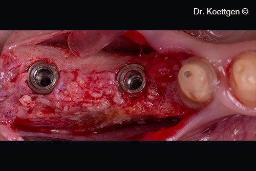 4. Placing implants after 3 month
